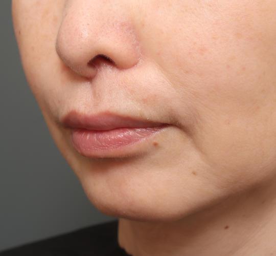 50代女性の人中短縮（リップリフト） After 症例写真