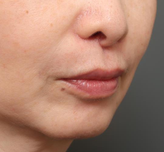 50代女性の人中短縮（リップリフト） After 症例写真