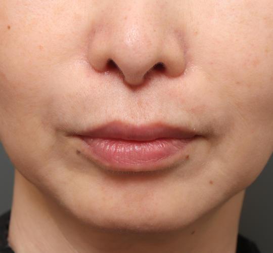 50代女性の人中短縮（リップリフト） After 症例写真