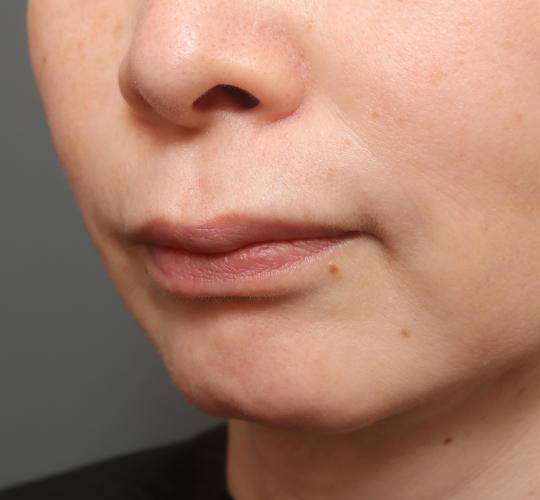 50代女性の人中短縮（リップリフト） Before 症例写真