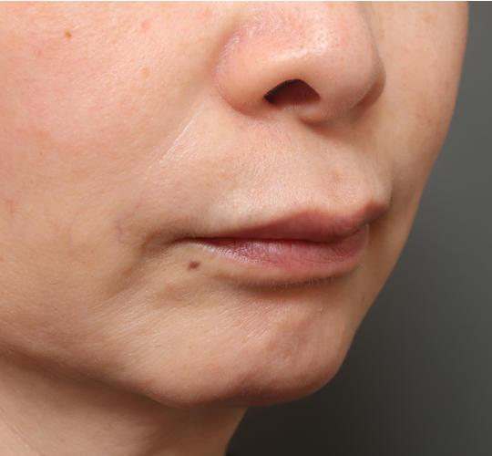 50代女性の人中短縮（リップリフト） Before 症例写真