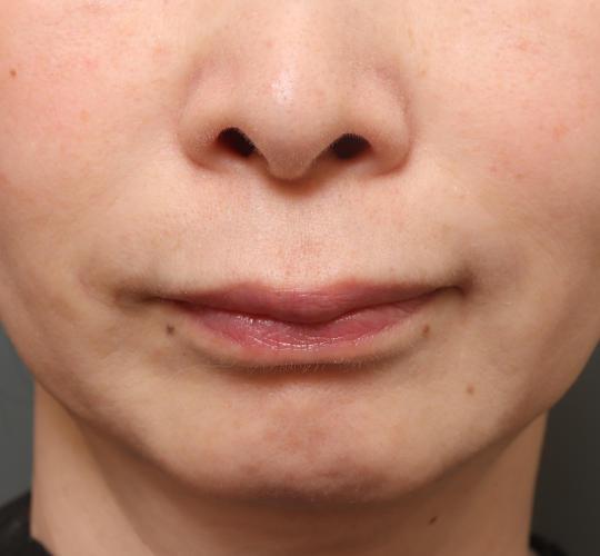 50代女性の人中短縮（リップリフト） Before 症例写真