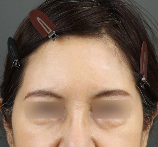 50代女性のヒアルロン酸注射（額） After 症例写真