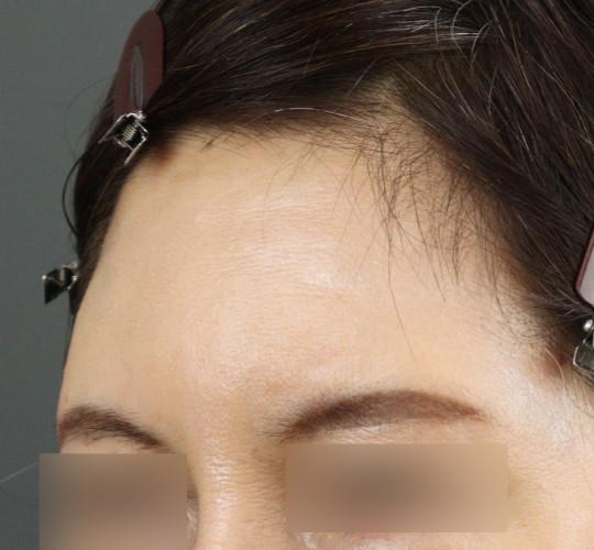 50代女性のエラ・アゴ・小顔 After 症例写真