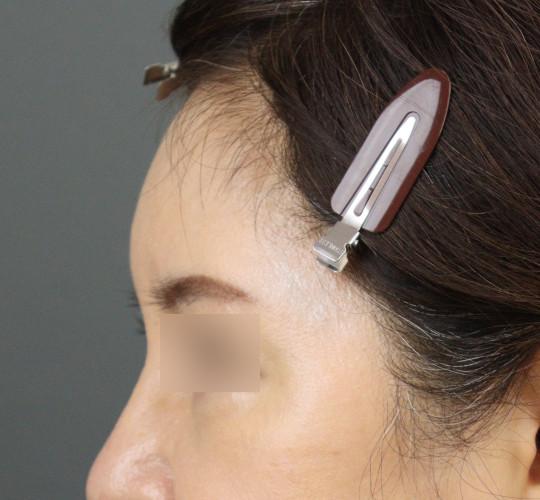 50代女性のヒアルロン酸注射（額） After 症例写真