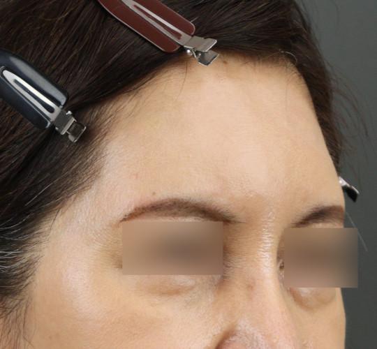 50代女性のヒアルロン酸注射（額） After 症例写真