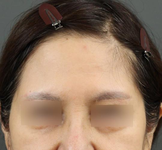 50代女性のヒアルロン酸注射（額） Before 症例写真