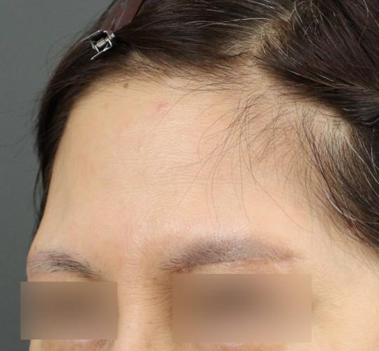 50代女性のエラ・アゴ・小顔 Before 症例写真