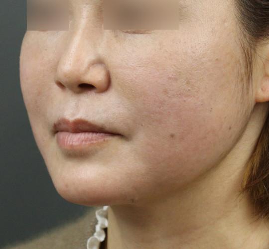 40代女性のボトックス（アゴ） After 症例写真