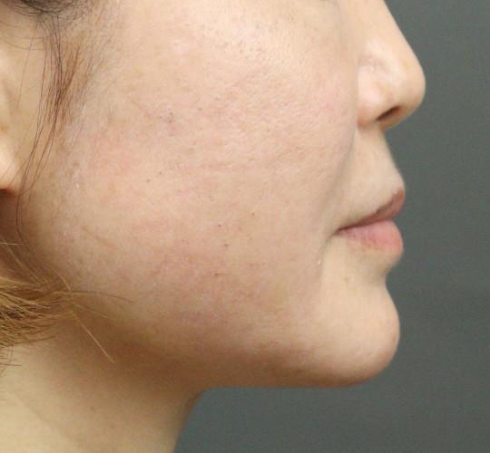 40代女性のエラ・アゴ・小顔 After 症例写真