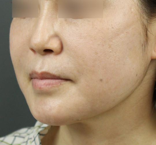 40代女性のボトックス（アゴ） Before 症例写真