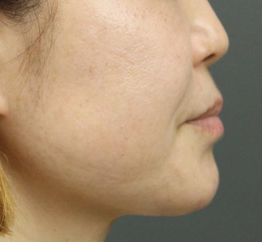 40代女性のエラ・アゴ・小顔 Before 症例写真