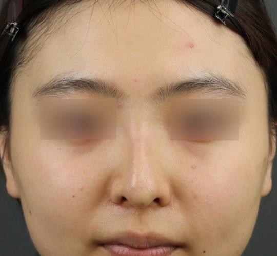 10代女性のヒアルロン酸注射（鼻形成） After 症例写真