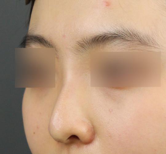 10代女性のヒアルロン酸注射（鼻形成） After 症例写真