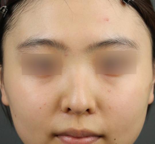 10代女性のヒアルロン酸注射（鼻形成） Before 症例写真