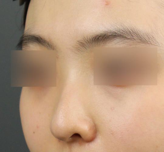 10代女性のヒアルロン酸注射（鼻形成） Before 症例写真