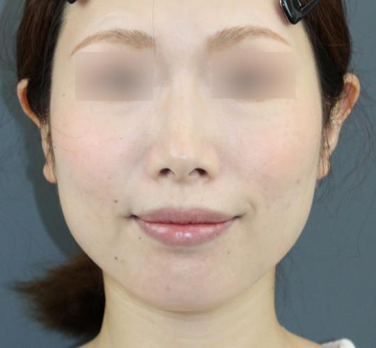 30代女性のエラ・アゴ・小顔 After 症例写真