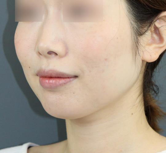 30代女性のボトックス（小顔） After 症例写真