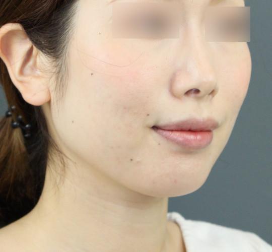 30代女性のボトックス（小顔） After 症例写真