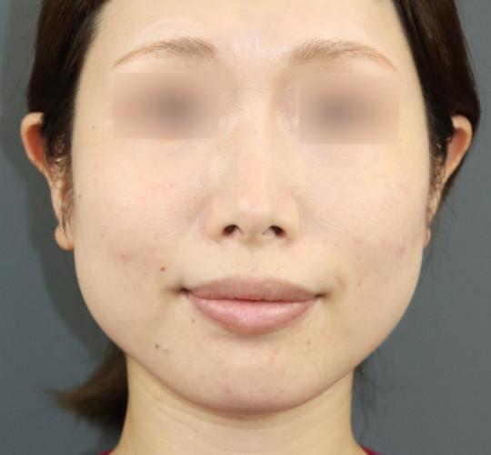 30代女性のエラ・アゴ・小顔 Before 症例写真