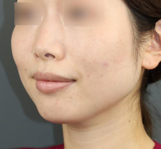 30代女性のボトックス（小顔） Before 症例写真