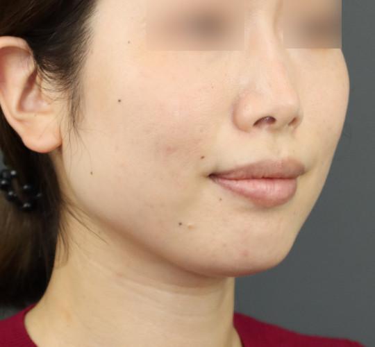 30代女性のボトックス（小顔） Before 症例写真