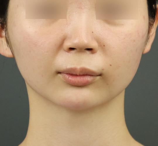 20代女性のヒアルロン酸注射（アゴ形成） After 症例写真