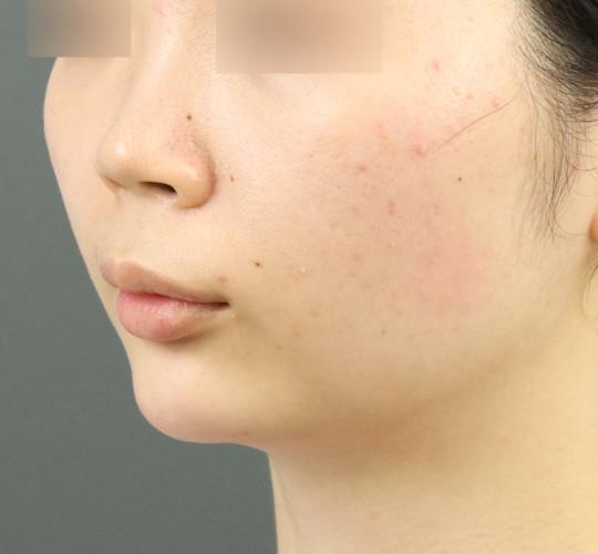 20代女性のヒアルロン酸注射（アゴ形成） After 症例写真