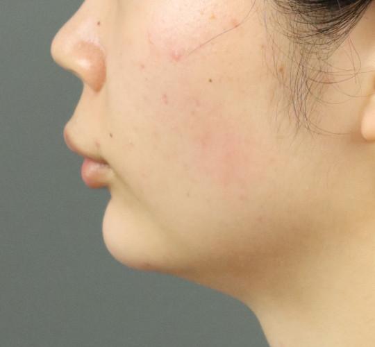 20代女性のエラ・アゴ・小顔 After 症例写真
