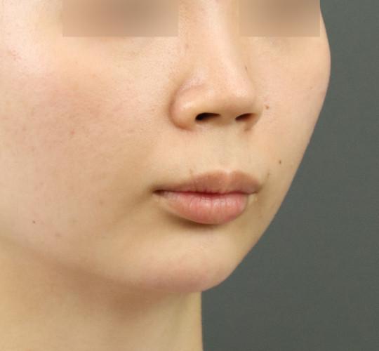 20代女性のヒアルロン酸注射（アゴ形成） After 症例写真