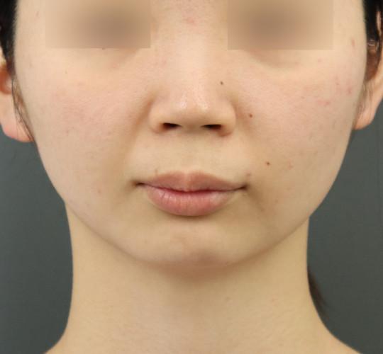 20代女性のヒアルロン酸注射（アゴ形成） Before 症例写真