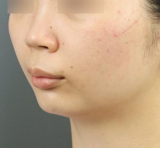 20代女性のヒアルロン酸注射（アゴ形成） Before 症例写真