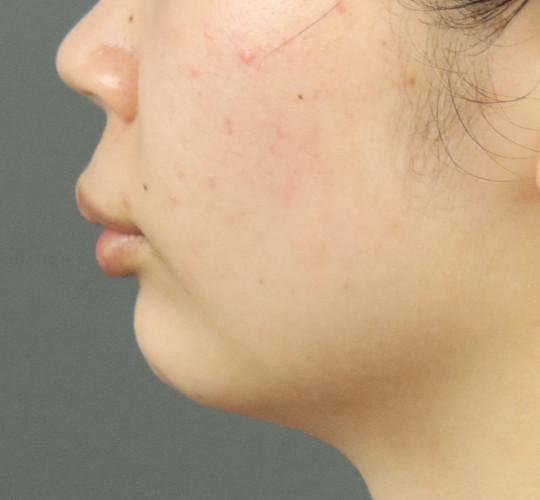 20代女性のエラ・アゴ・小顔 Before 症例写真