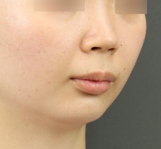 20代女性のヒアルロン酸注射（アゴ形成） Before 症例写真