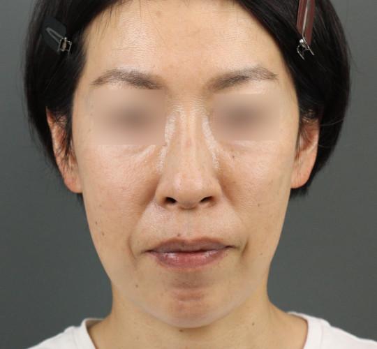 40代女性のヒアルロン酸注射  After 症例写真