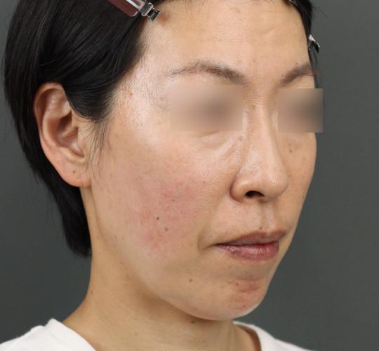 40代女性のエラ・アゴ・小顔 After 症例写真