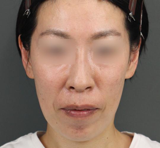 40代女性のヒアルロン酸注射  Before 症例写真
