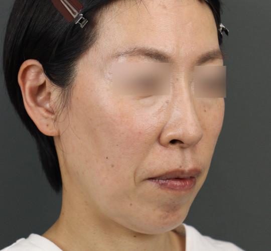 40代女性のエラ・アゴ・小顔 Before 症例写真