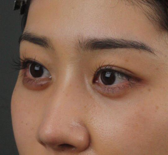 20代女性のヒアルロン酸注射（涙袋） After 症例写真