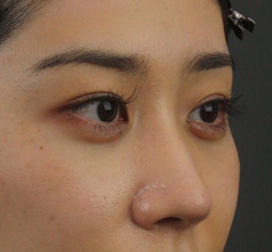 20代女性のヒアルロン酸注射（涙袋） After 症例写真