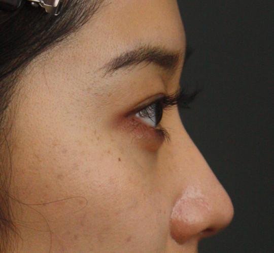 20代女性のヒアルロン酸注射（涙袋） After 症例写真