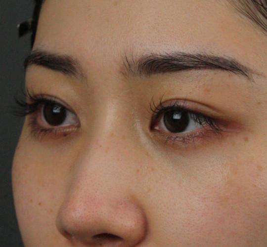 20代女性のヒアルロン酸注射（涙袋） Before 症例写真