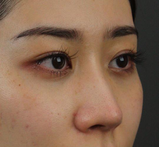 20代女性のヒアルロン酸注射（涙袋） Before 症例写真