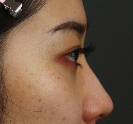 20代女性のヒアルロン酸注射（涙袋） Before 症例写真