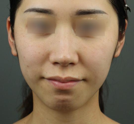 20代女性のテスリフトノーズ After 症例写真