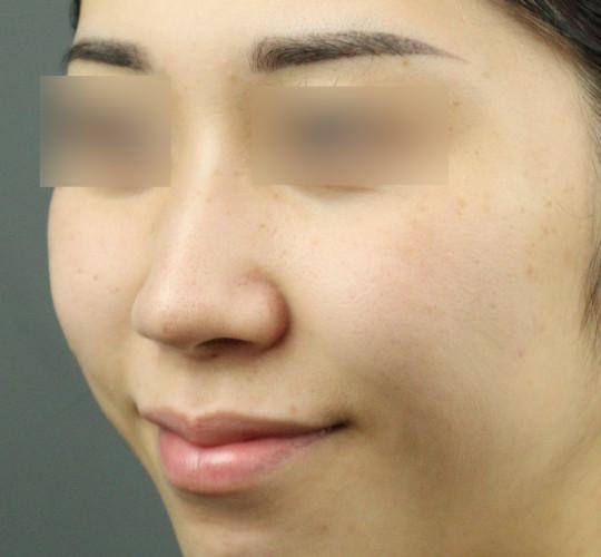 20代女性の鼻の整形 After 症例写真