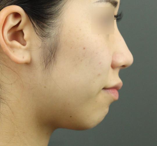 20代女性のテスリフトノーズ After 症例写真