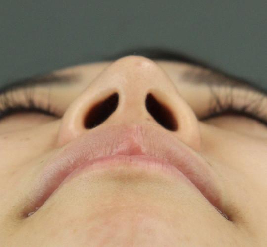 20代女性のテスリフトノーズ After 症例写真