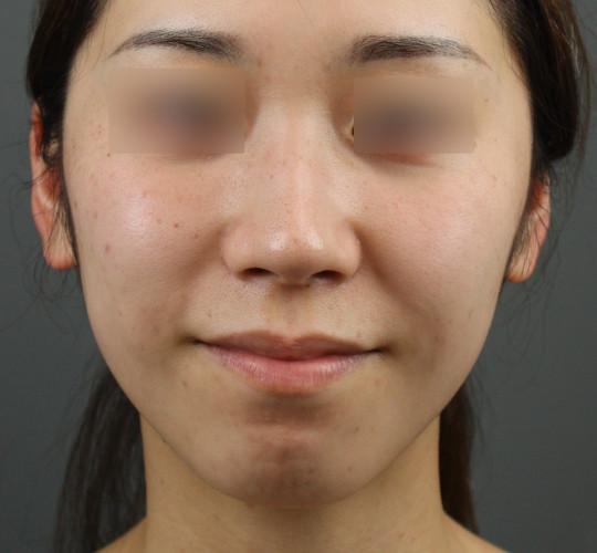 20代女性のテスリフトノーズ Before 症例写真