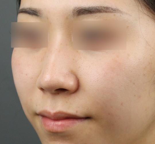 20代女性の鼻の整形 Before 症例写真